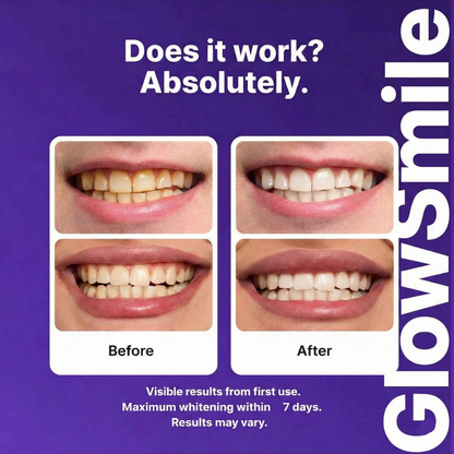 GlowSmile™ Purple Color-Correcting Whitening Strips | Instant Brightness & Enamel-Safe
